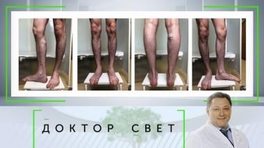 Варикозное расширение вен и тяжелый характер у пожилых людей 20.06.2019